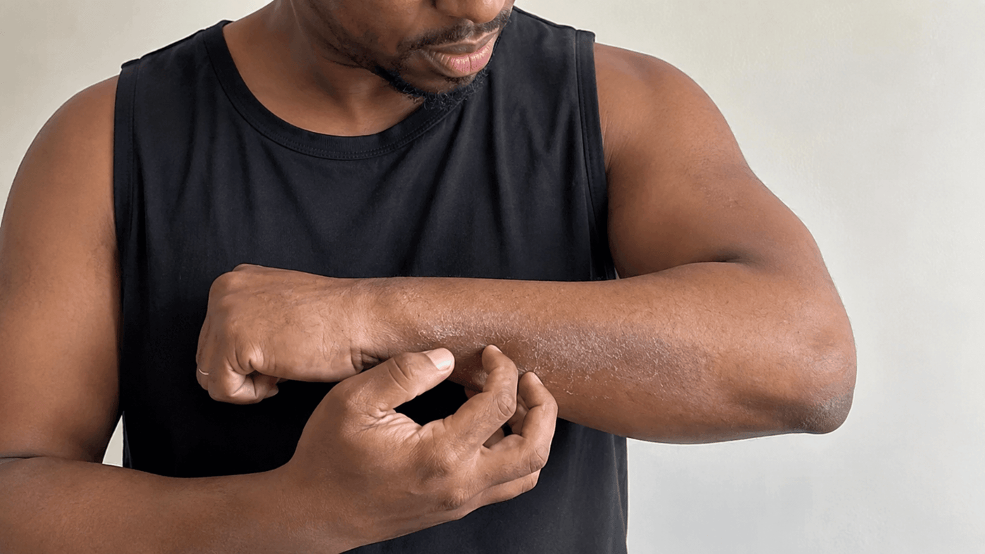 7 Surprising Triggers of Eczema: Stay Informed and Itch-Free!