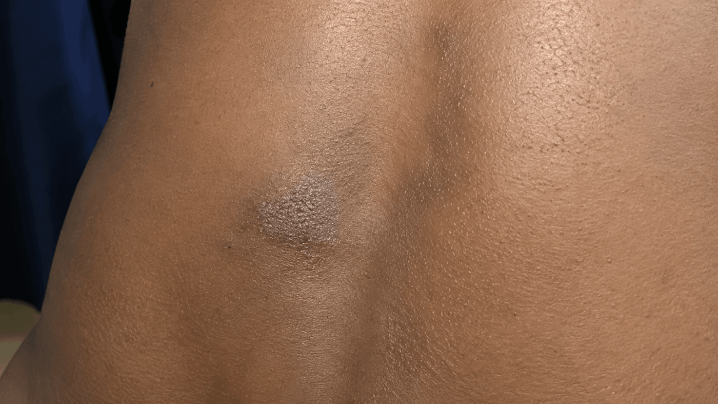 What's with Eczema? Understanding the Causes and Solutions