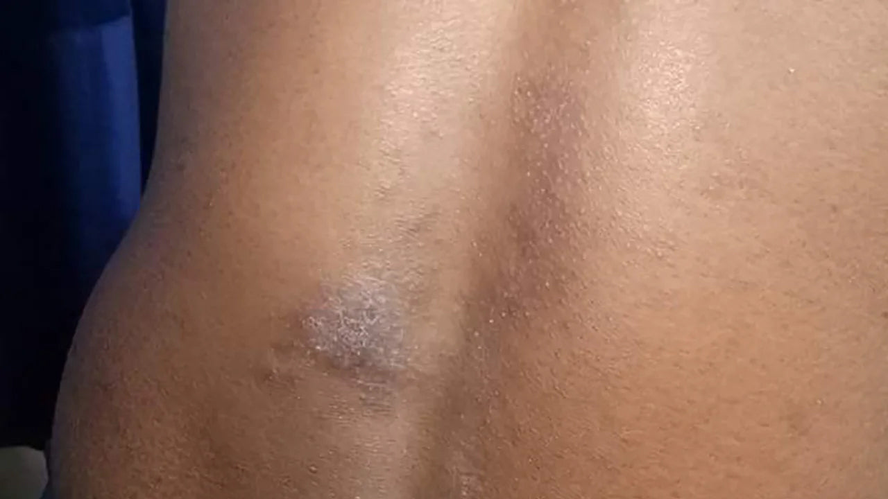 What's with Eczema? Understanding the Causes and Solutions